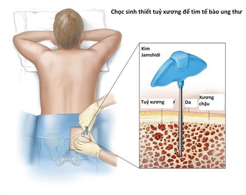 Sinh thiết tủy xương là gì? Vai trò của sinh thiết tủy xương trong chẩn đoán và điều trị